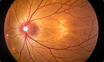 Glaucoma
